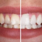 Restoring Damaged Teeth with Cosmetic Dentistry