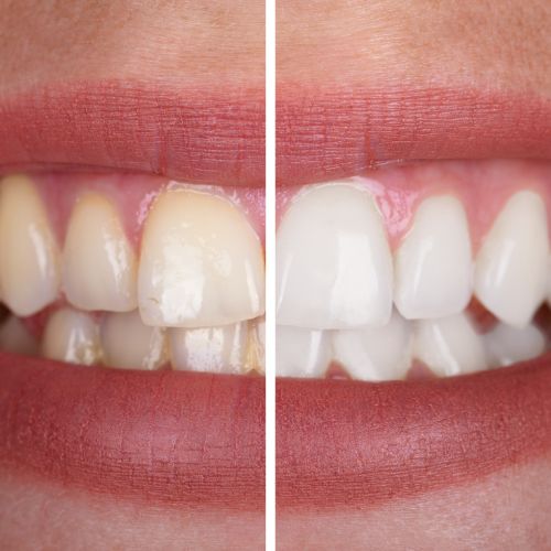 Restoring Damaged Teeth with Cosmetic Dentistry